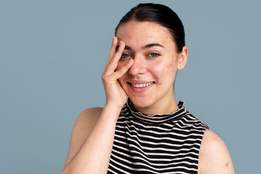 ¿Piel grasa en verano? Consejos para controlar el brillo y prevenir brotes