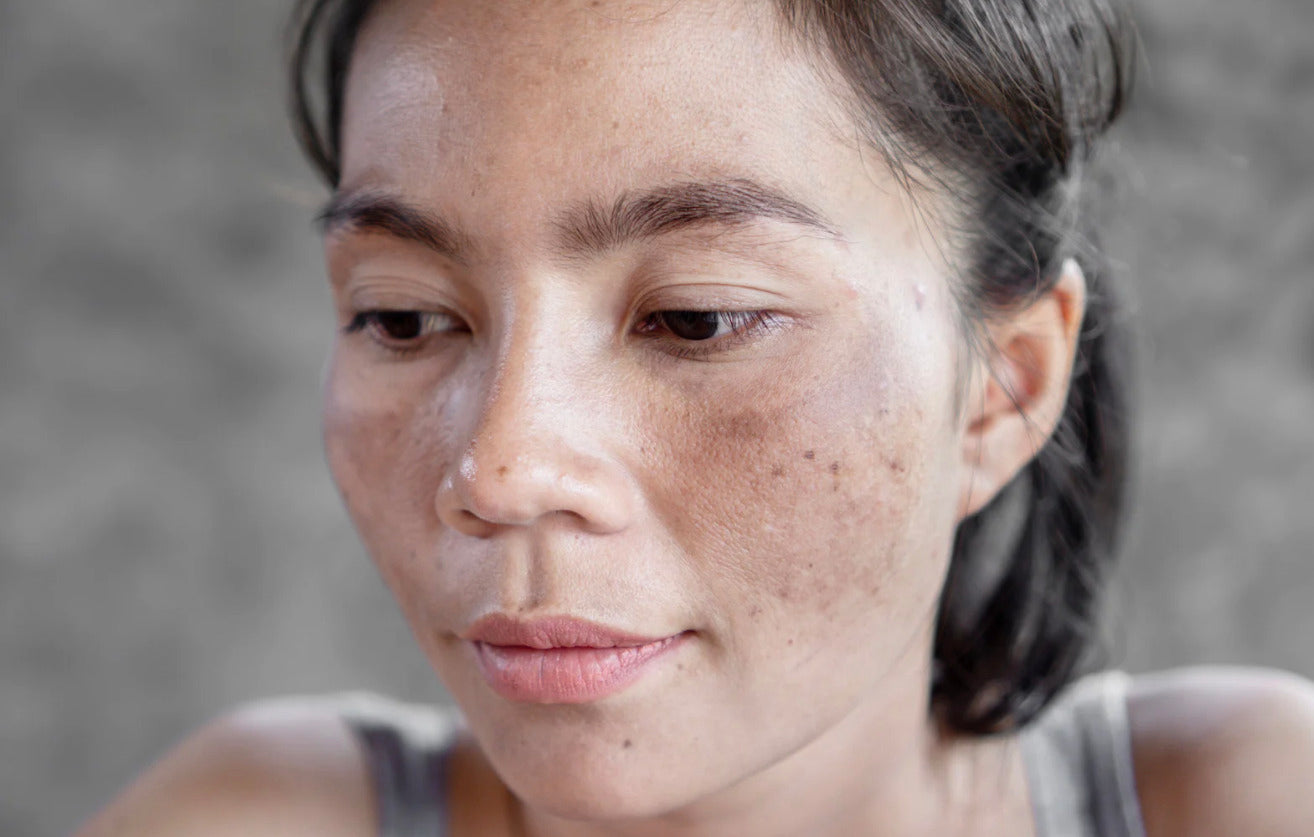 Patrón centrofacial del melasma en piel con fototipo III: manchas simétricas en frente y mejillas