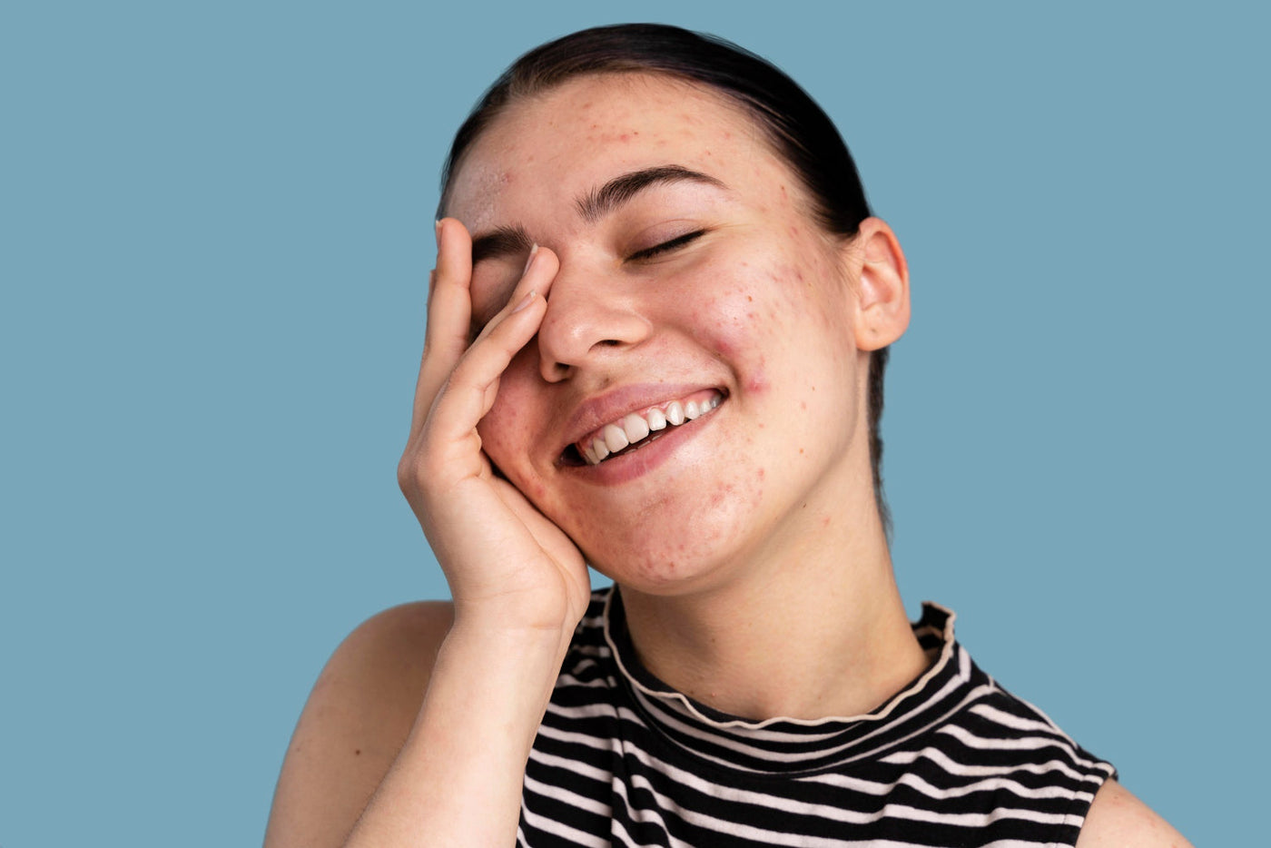 Mujer sonríe y cubre parcialmente su cara con la mano. En su piel se notan algunas marcas de acné, que puede ser una característica de la piel grasa.